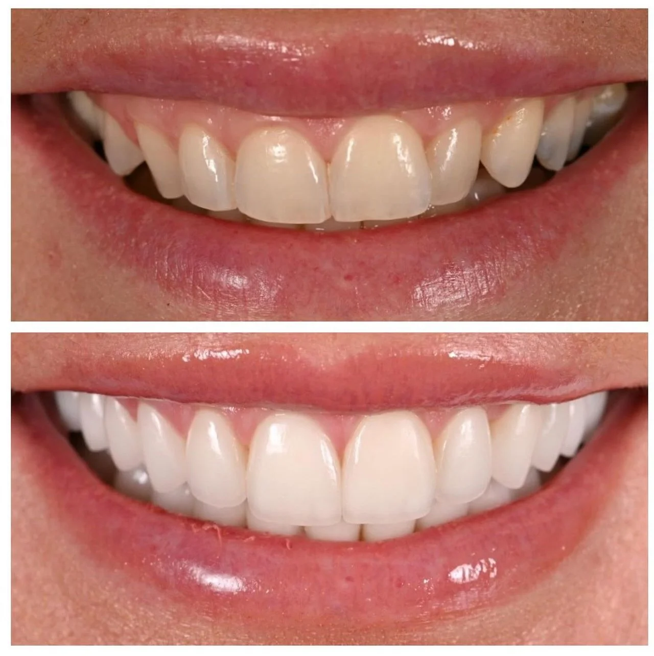 Full Smile Restoration